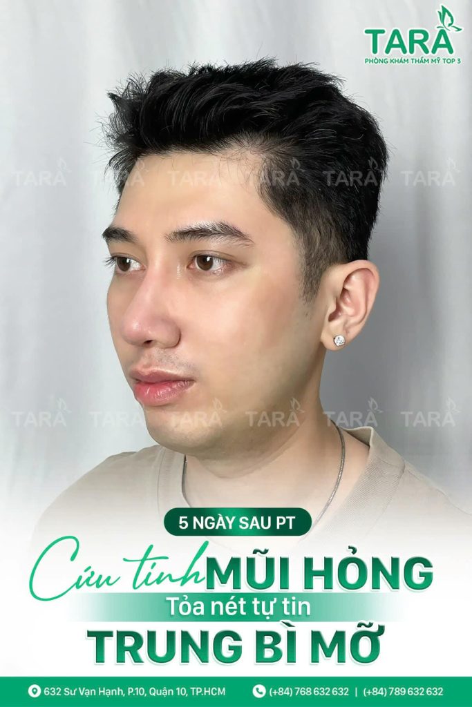 TS.BS Trang: 4 hiểu lầm về nâng mũi không nẹp cứng