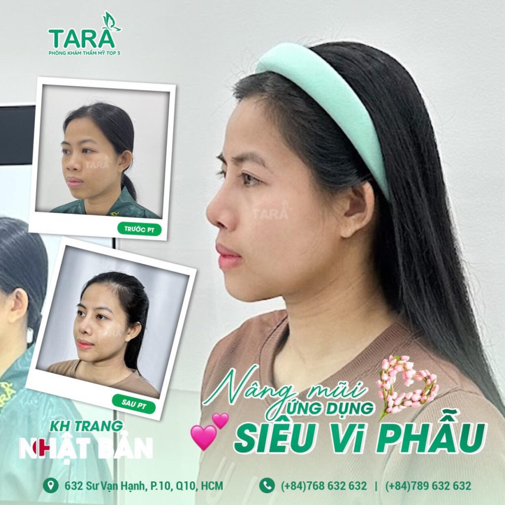 Nâng mũi không nẹp cứng: Lựa chọn số 1 cho người livestream