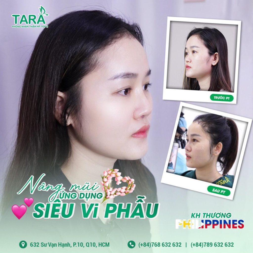 Nâng mũi không nẹp cứng: Lựa chọn số 1 cho người livestream