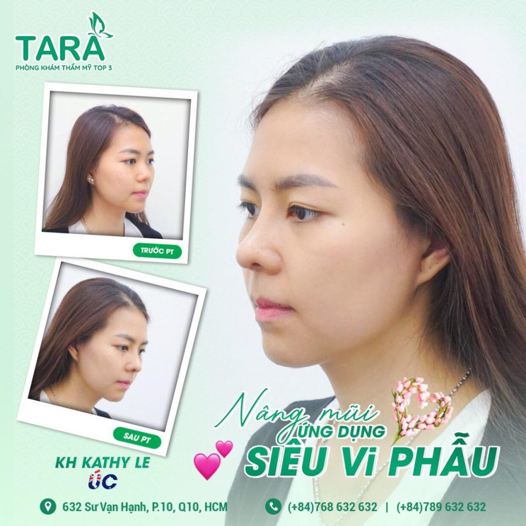 TS-BS Trang: Nâng mũi siêu vi phẫu không nẹp cứng, 03 ngày vào form