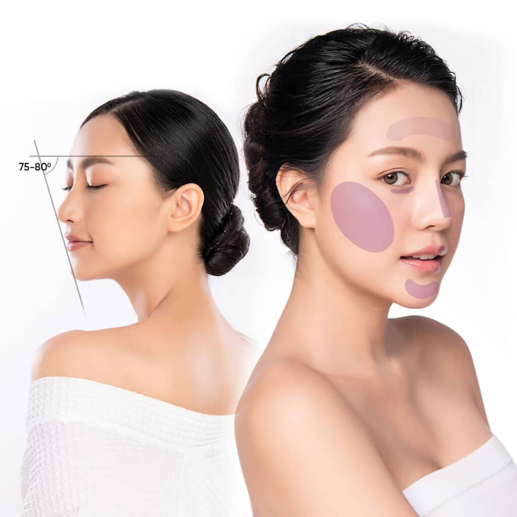 Bao lâu thấy hiệu quả khi tiêm filler tạo hình khuôn mặt?