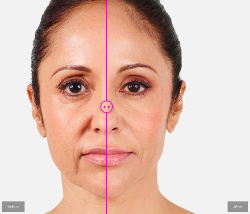 Tiêm filler Radiesse - Hiệu quả trẻ hoá gấp 3