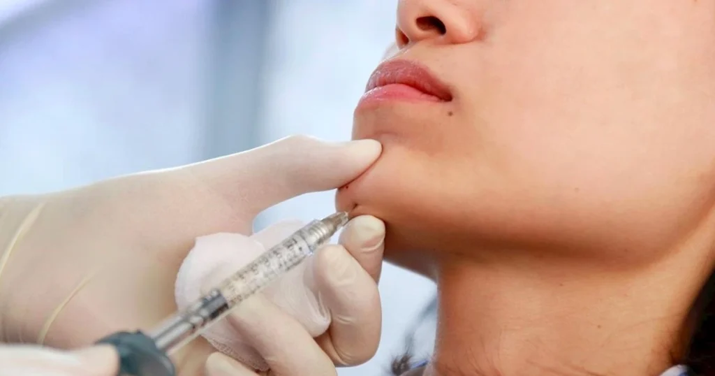 Bảng giá tiêm filler tạo hình khuôn mặt 2025
