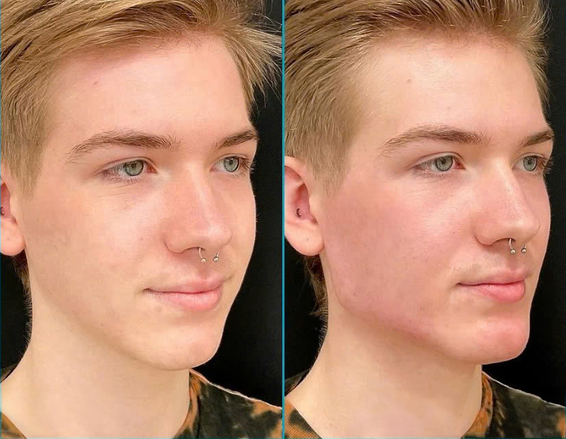 Tiêm filler tạo hình khuôn mặt cho người đi làm
