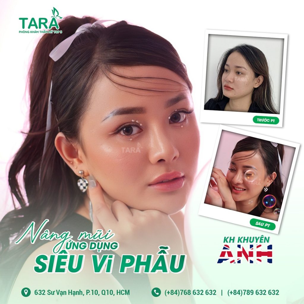 Review thực tế: Nâng mũi siêu vi phẫu – Không đau, không sưng?