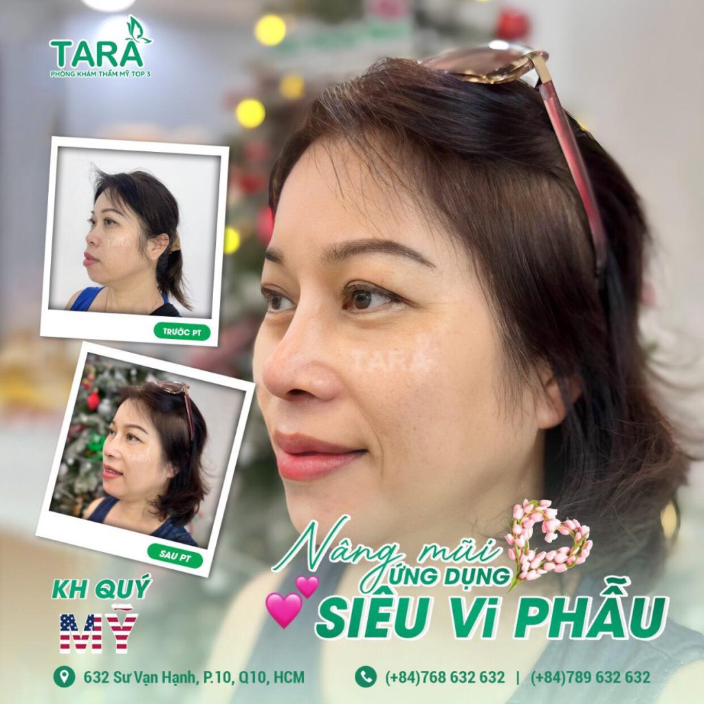 Nâng mũi siêu vi phẫu là gì? Ưu điểm và nhược điểm
