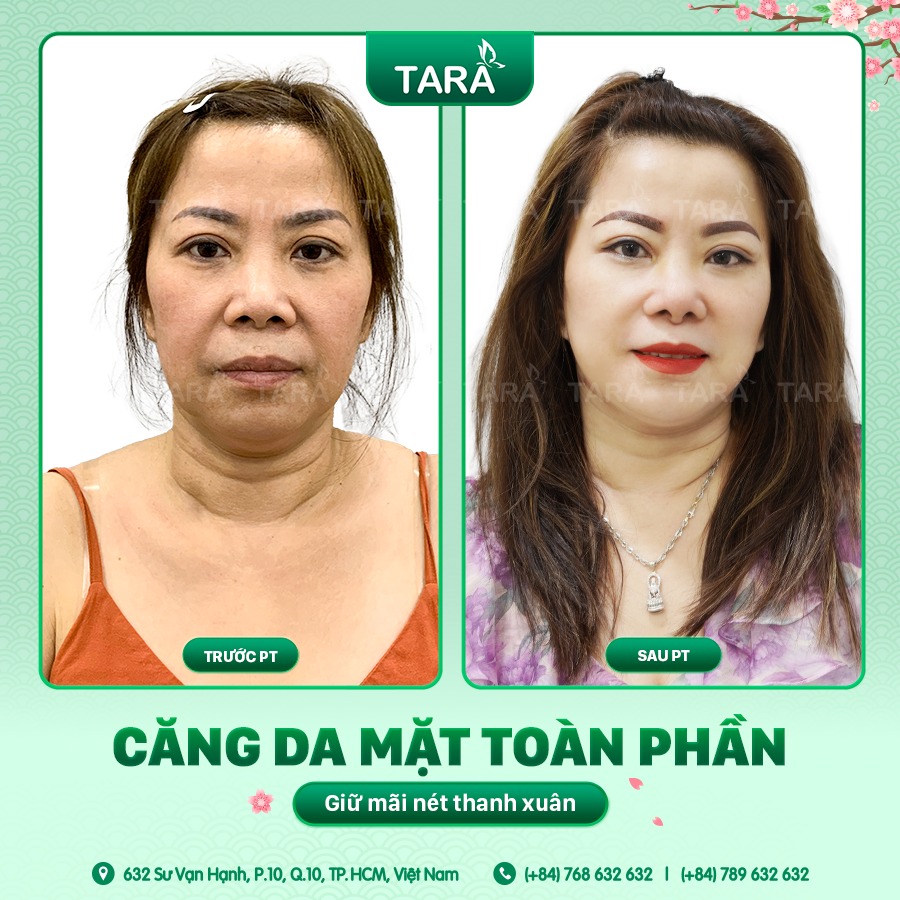 Kinh nghiệm chọn địa chỉ căng da mặt uy tín